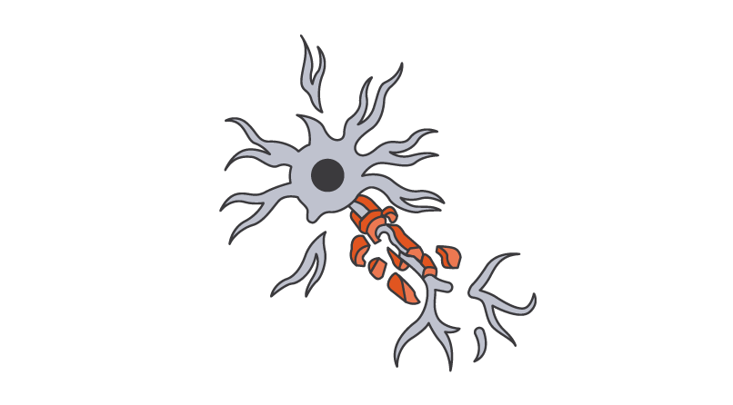 Illustration montrant une perte synaptique induite par les microglies